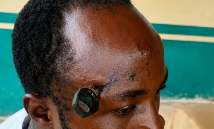 Jasikan okada brawl leaves rider with critical skull wound; Korle Bu provides specialist care