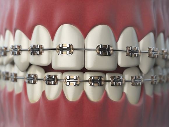 Ghana's Gen Z braces craze: dental trend or health hazard?